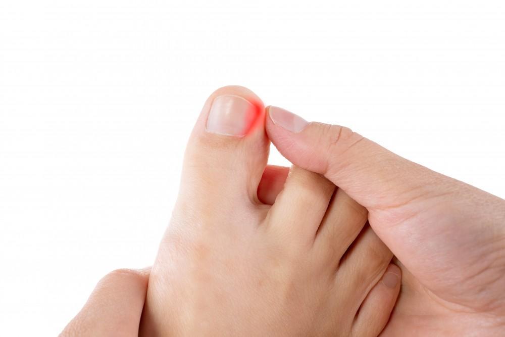 ingrown toenail