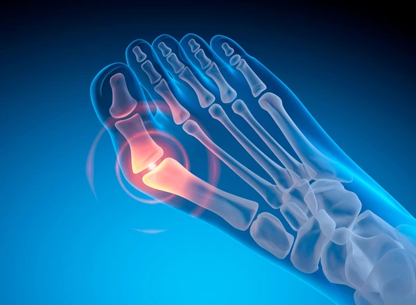 bunion
