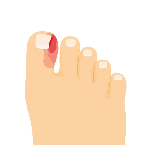 ingrown toenail