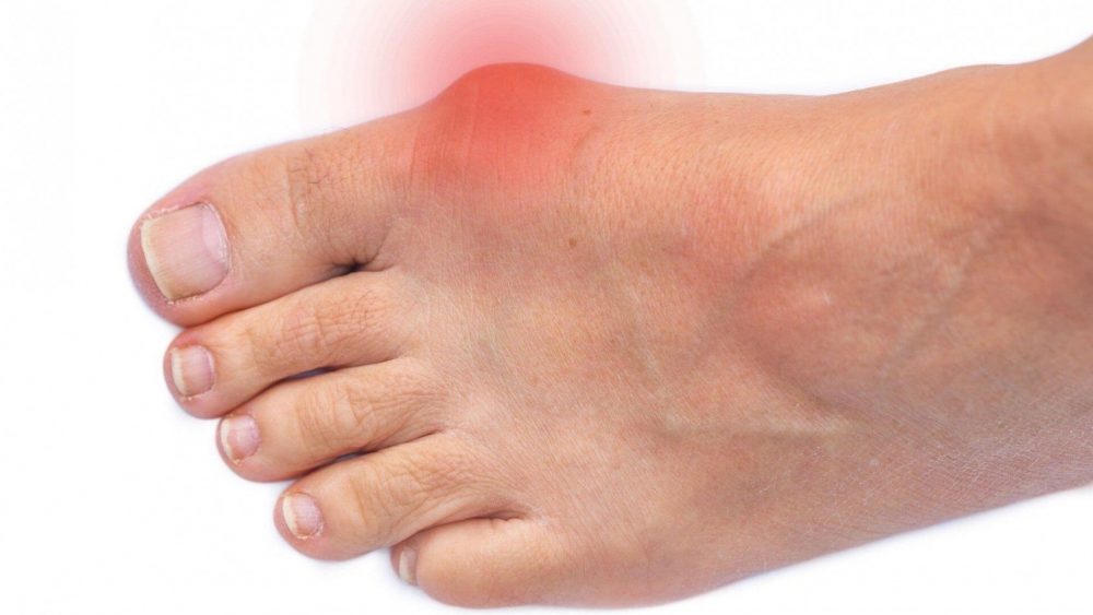 Bunion-pain_1692x952a (1)