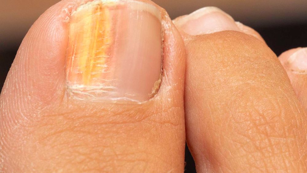 Does-Toenail-Fungus-Ever-Go-Away-on-Its-Own