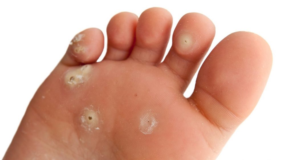 plantar wart
